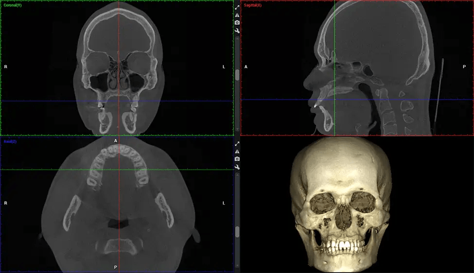 Planmeca CBCT Low Radiation G7 Full Skull Imaging Miami