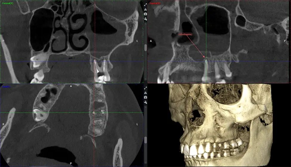 Tratamiento dental en la clínica dental del Dr. G en Miami.