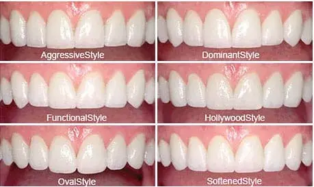 Comparación de estilos de carillas de porcelana, Dr. G Dental Studio Miami